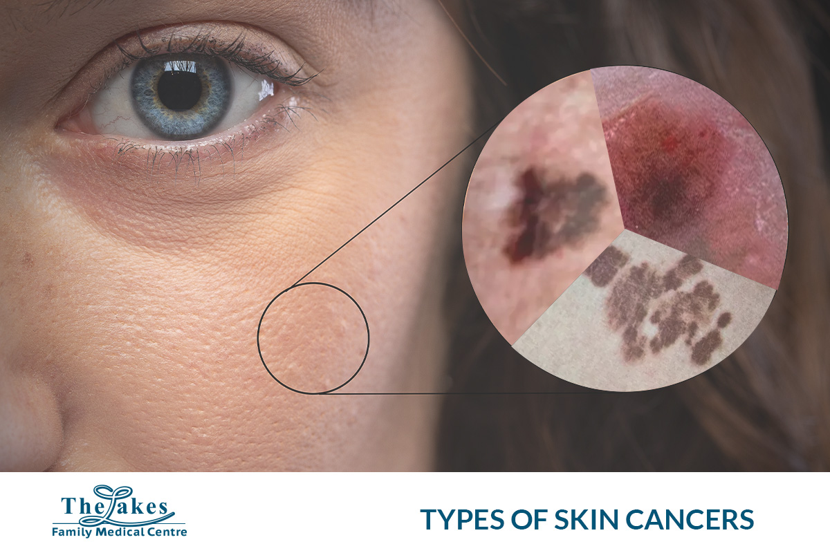 Types of Skin Cancers