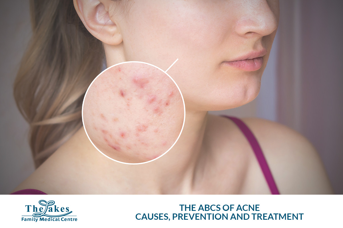 The ABCs of Acne: Causes, Prevention, and Treatment