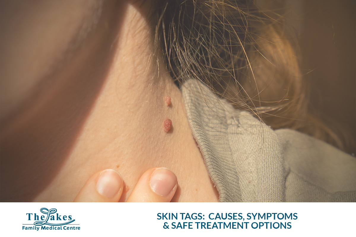 Skin Tags: Causes, Symptoms and Safe Treatment Options